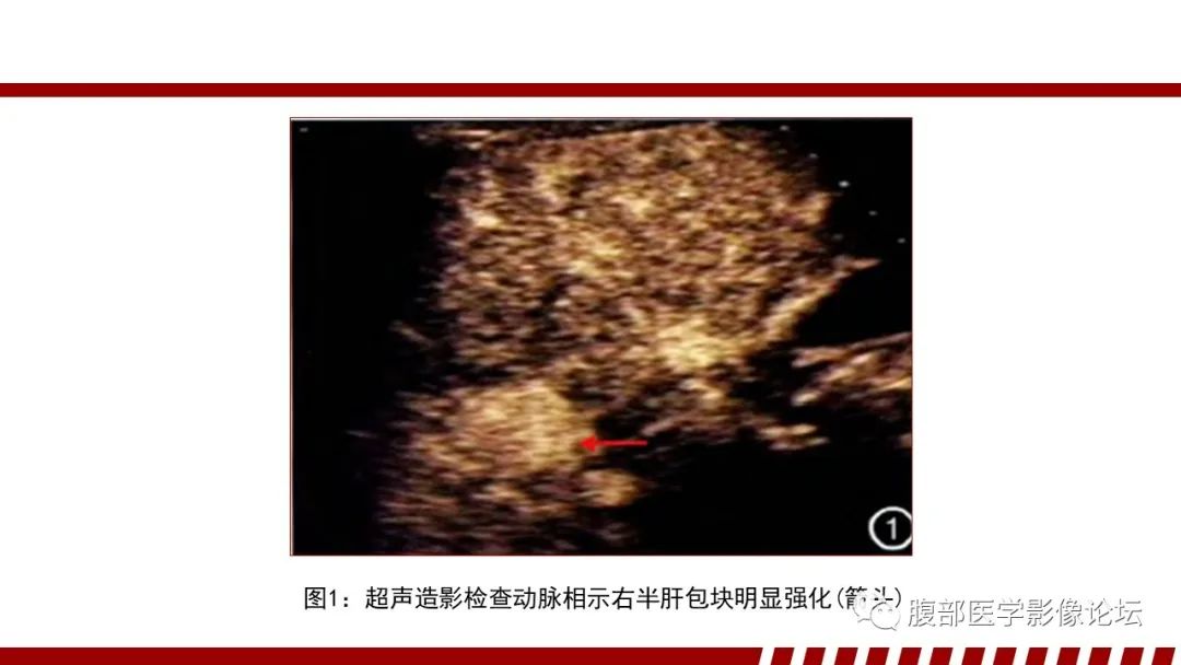 影像PPT - 【PPT】肝脏血液系统疾病影像综述-86