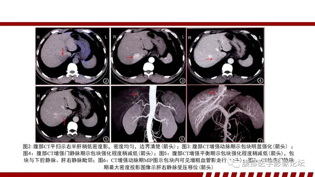 影像PPT - 【PPT】肝脏血液系统疾病影像综述-87