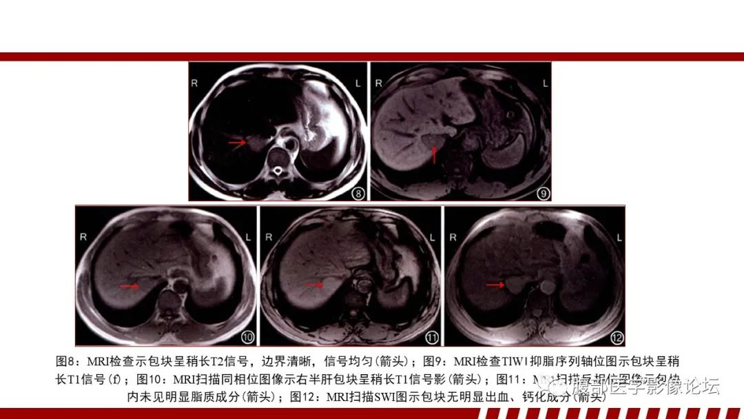影像PPT - 【PPT】肝脏血液系统疾病影像综述-88