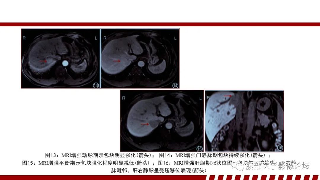 影像PPT - 【PPT】肝脏血液系统疾病影像综述-89