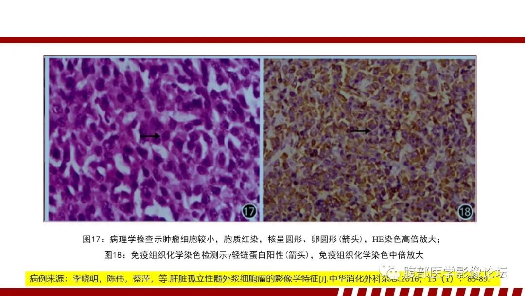 影像PPT - 【PPT】肝脏血液系统疾病影像综述-90