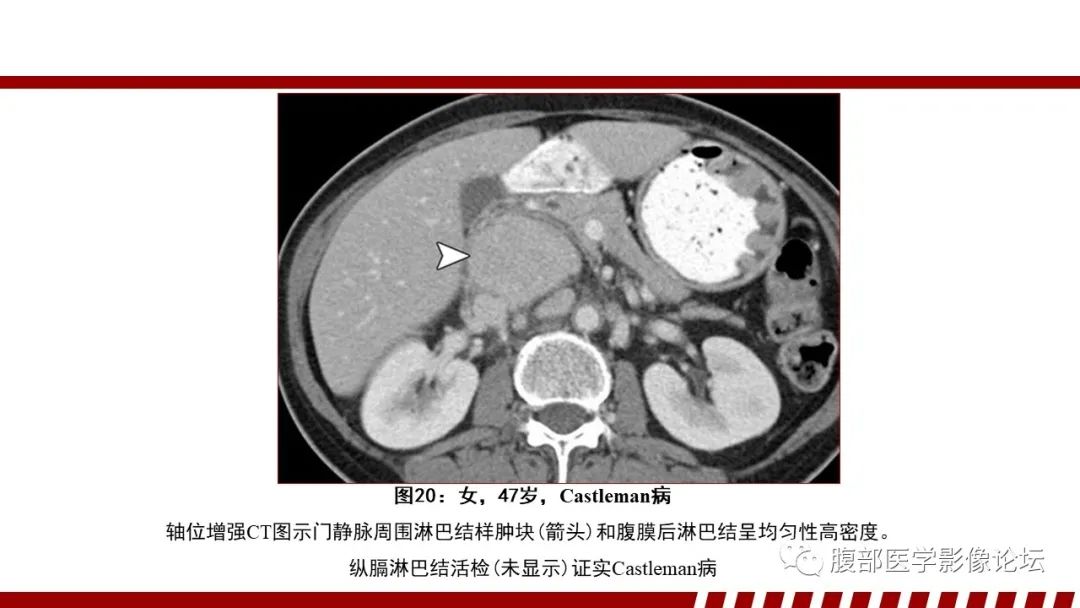 影像PPT - 【PPT】肝脏血液系统疾病影像综述-101