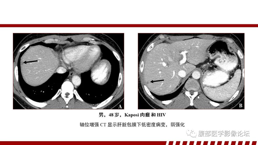 影像PPT - 【PPT】肝脏血液系统疾病影像综述-106