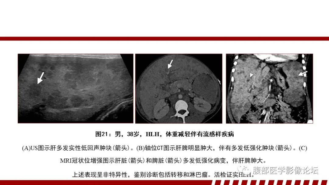 影像PPT - 【PPT】肝脏血液系统疾病影像综述-119