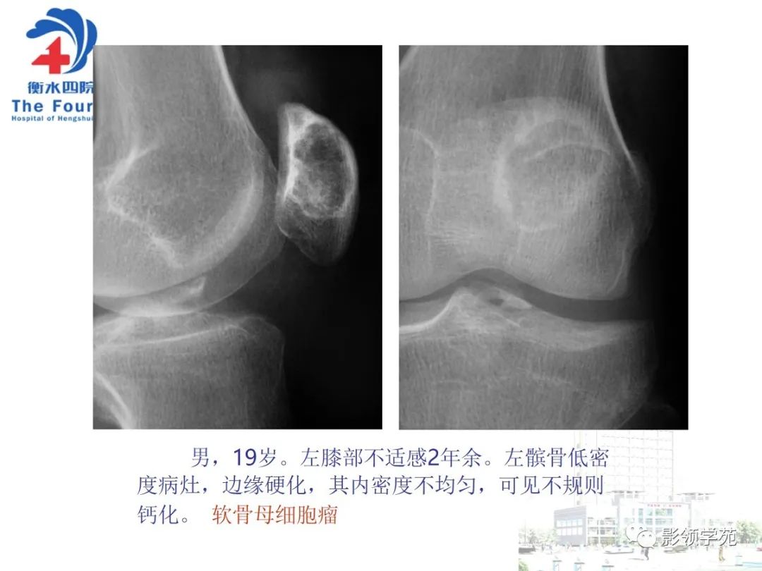影像PPT - 【PPT】髌骨肿瘤的影像特点-5 影像PPT - 【PPT】髌骨肿瘤的影像特点-5