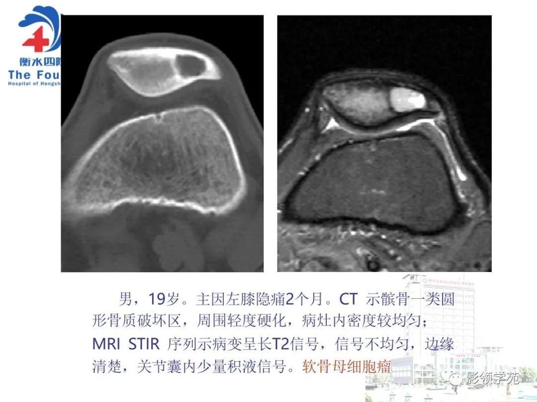 影像PPT - 【PPT】髌骨肿瘤的影像特点-7 影像PPT - 【PPT】髌骨肿瘤的影像特点-7