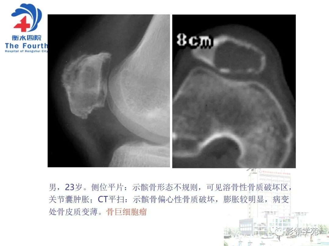 影像PPT - 【PPT】髌骨肿瘤的影像特点-9 影像PPT - 【PPT】髌骨肿瘤的影像特点-9
