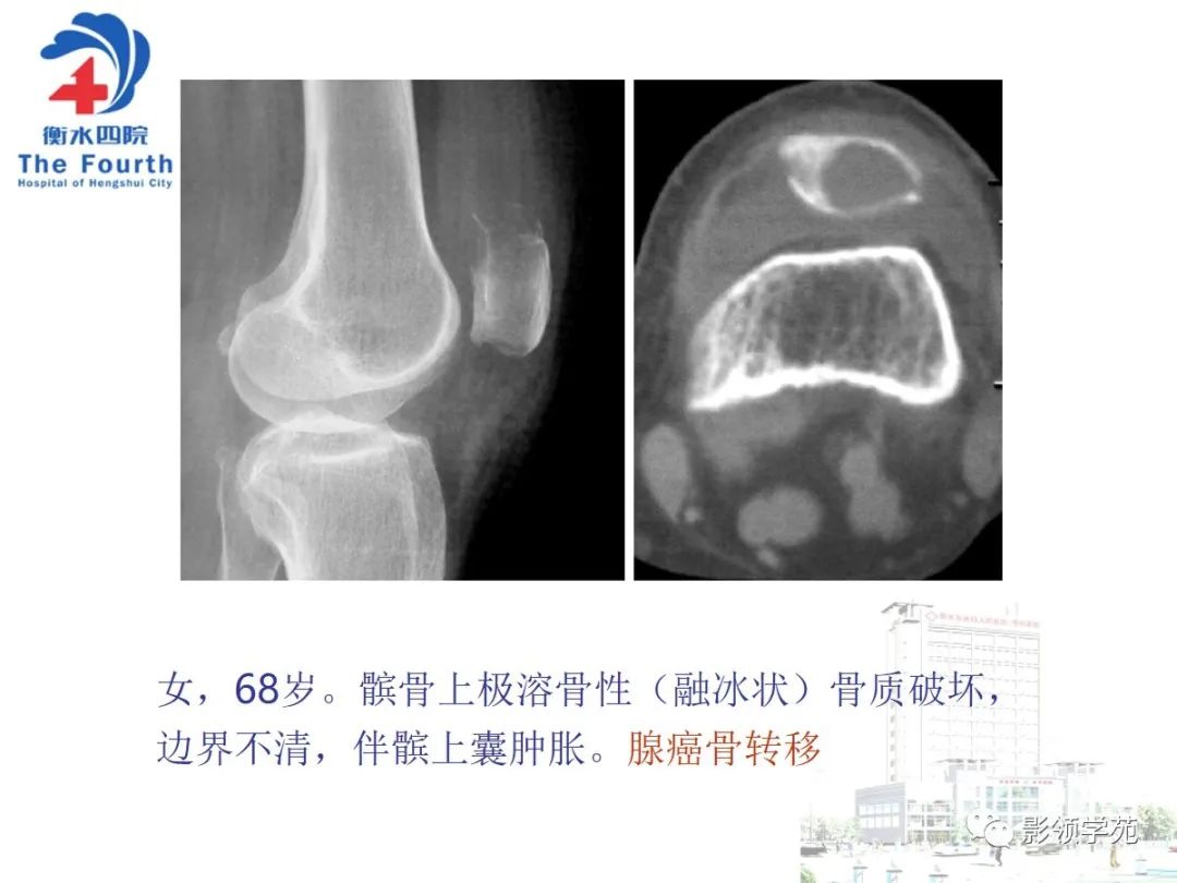 影像PPT - 【PPT】髌骨肿瘤的影像特点-12 影像PPT - 【PPT】髌骨肿瘤的影像特点-12