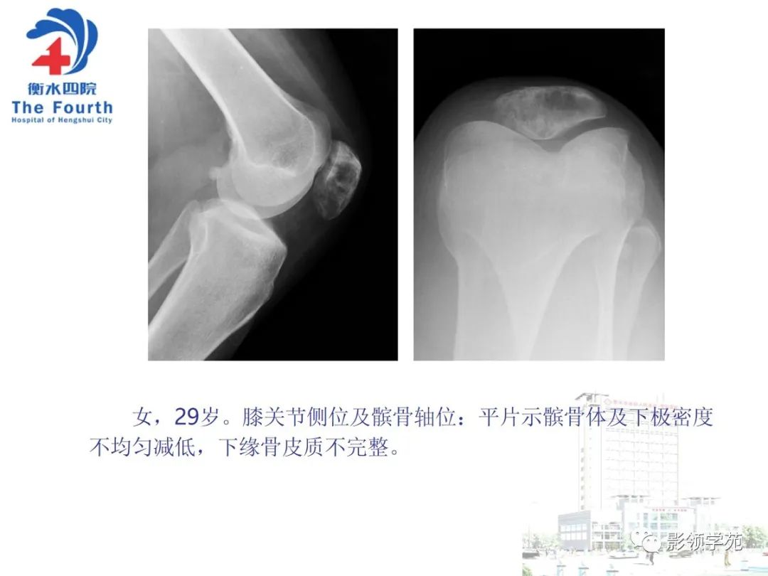 影像PPT - 【PPT】髌骨肿瘤的影像特点-14 影像PPT - 【PPT】髌骨肿瘤的影像特点-14