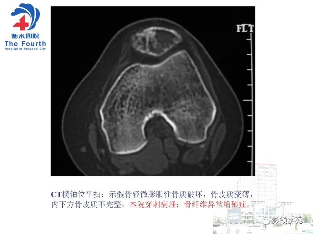 影像PPT - 【PPT】髌骨肿瘤的影像特点-15 影像PPT - 【PPT】髌骨肿瘤的影像特点-15