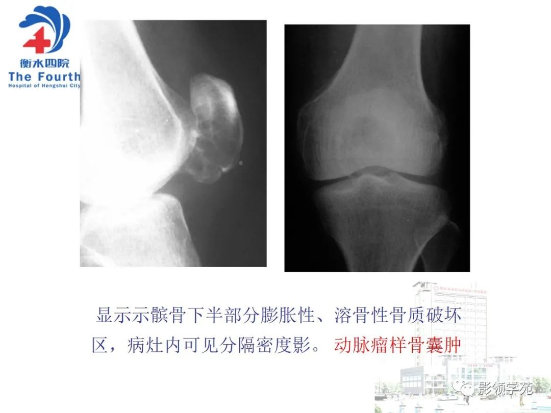 影像PPT - 【PPT】髌骨肿瘤的影像特点-19 影像PPT - 【PPT】髌骨肿瘤的影像特点-19