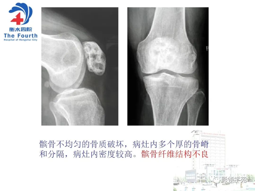 影像PPT - 【PPT】髌骨肿瘤的影像特点-20 影像PPT - 【PPT】髌骨肿瘤的影像特点-20