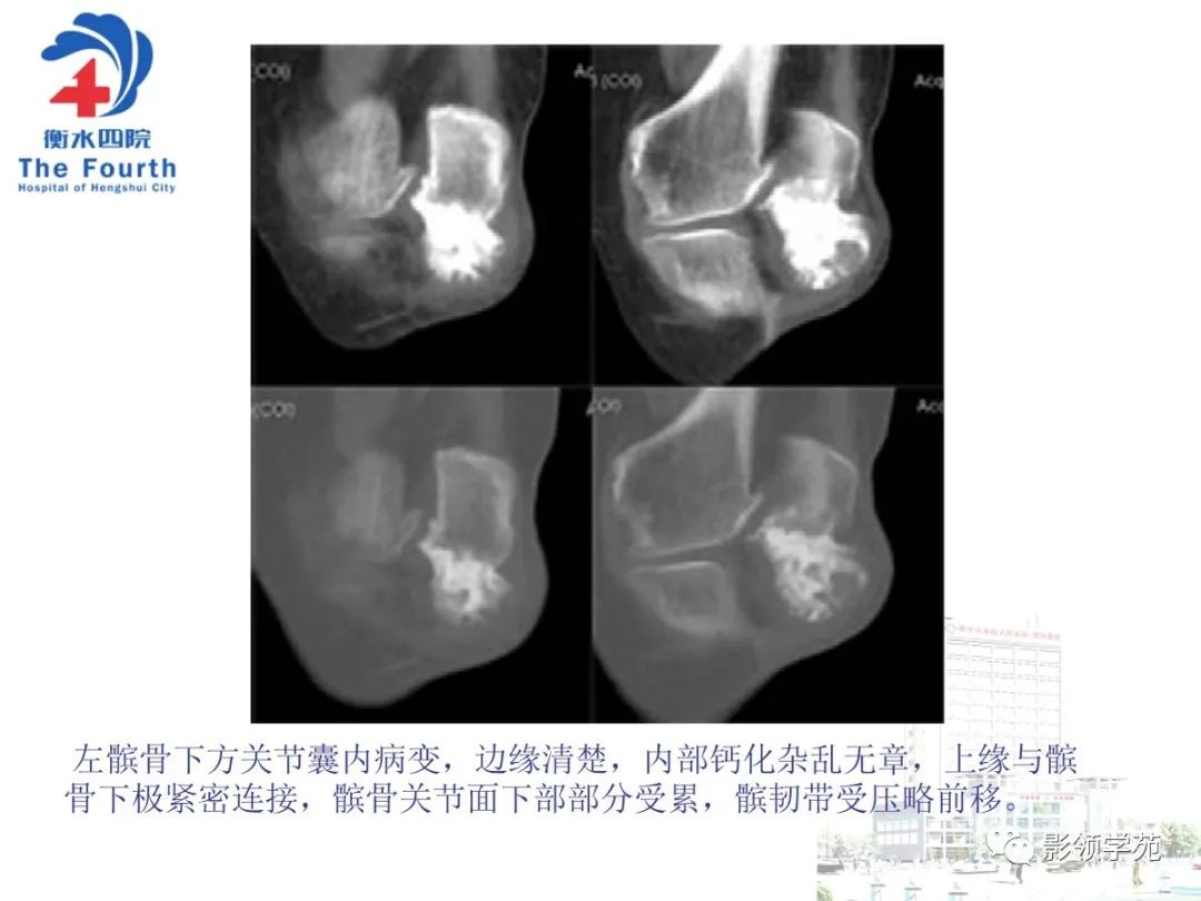 影像PPT - 【PPT】髌骨肿瘤的影像特点-24 影像PPT - 【PPT】髌骨肿瘤的影像特点-24