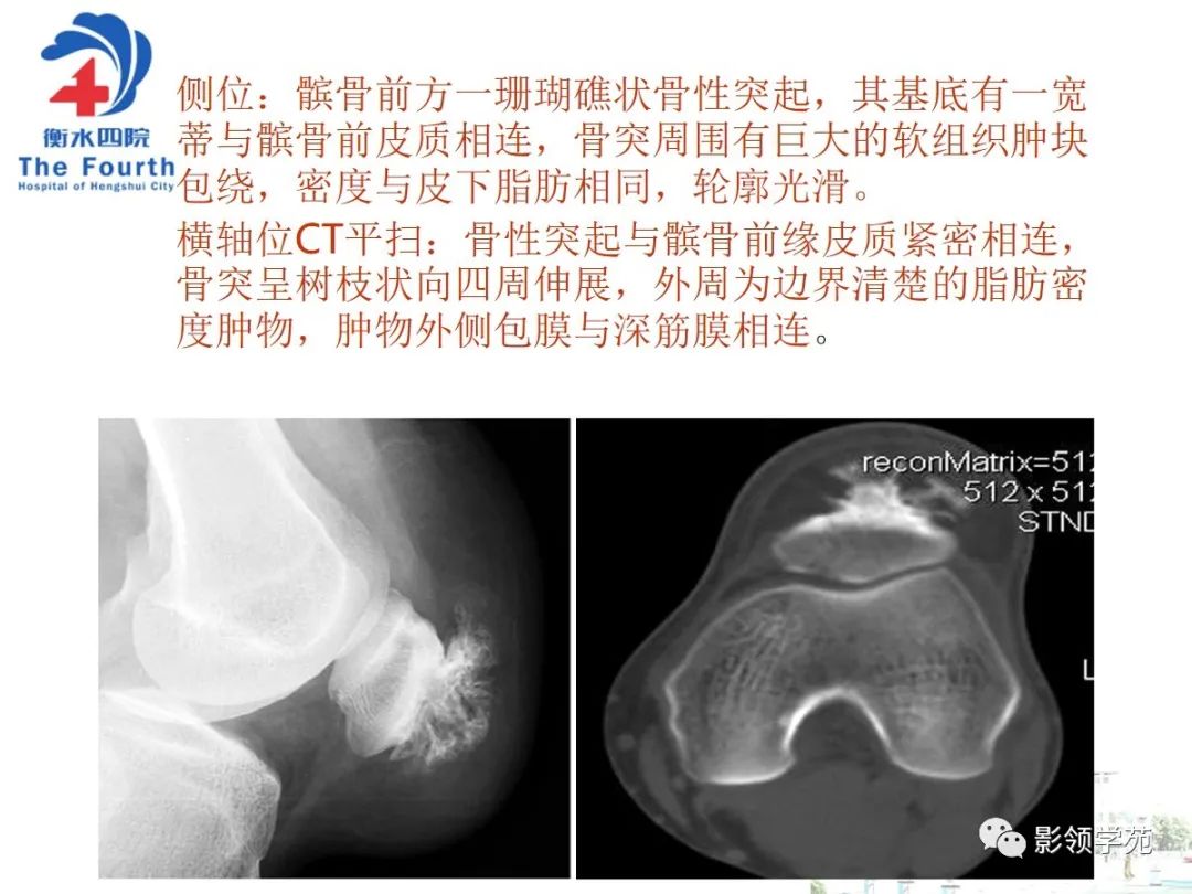 影像PPT - 【PPT】髌骨肿瘤的影像特点-28 影像PPT - 【PPT】髌骨肿瘤的影像特点-28