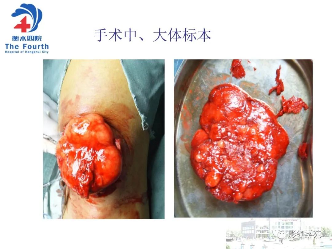 影像PPT - 【PPT】髌骨肿瘤的影像特点-29 影像PPT - 【PPT】髌骨肿瘤的影像特点-29