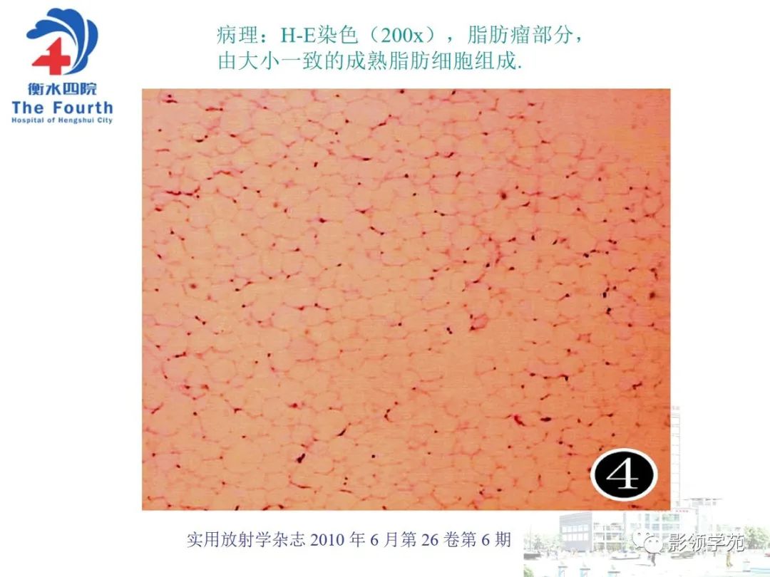 影像PPT - 【PPT】髌骨肿瘤的影像特点-31 影像PPT - 【PPT】髌骨肿瘤的影像特点-31