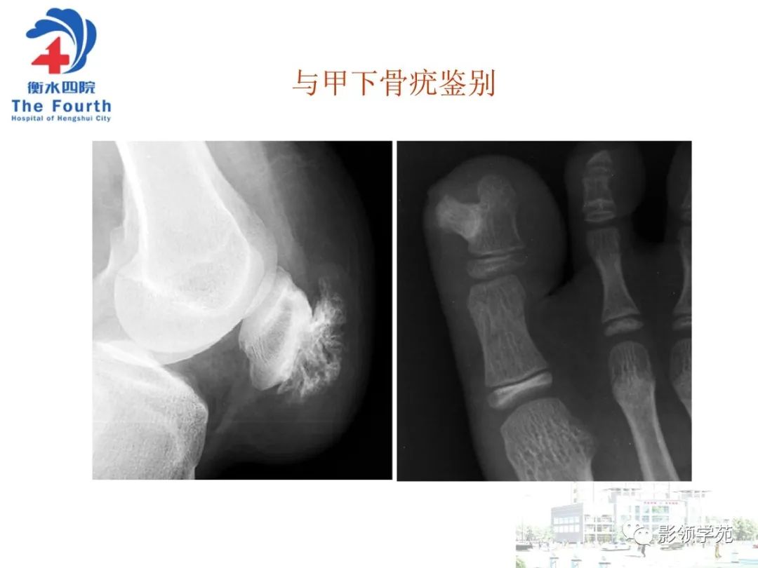 影像PPT - 【PPT】髌骨肿瘤的影像特点-33 影像PPT - 【PPT】髌骨肿瘤的影像特点-33