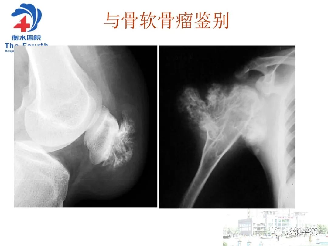 影像PPT - 【PPT】髌骨肿瘤的影像特点-34 影像PPT - 【PPT】髌骨肿瘤的影像特点-34