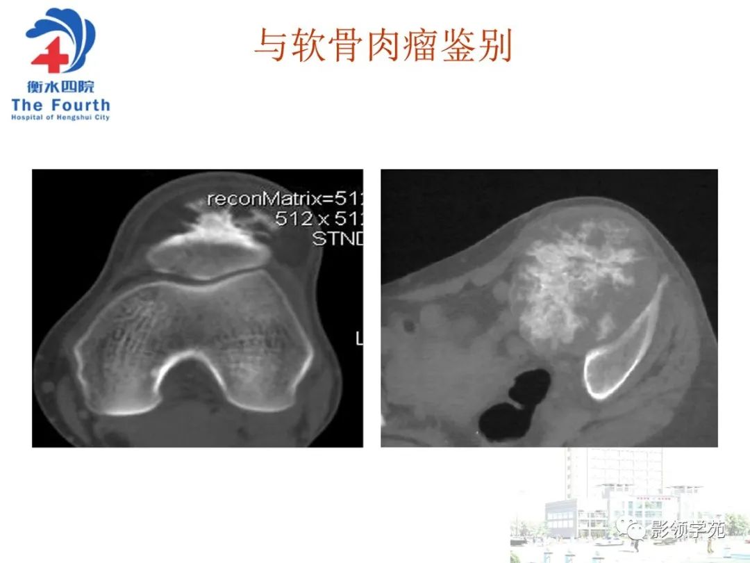 影像PPT - 【PPT】髌骨肿瘤的影像特点-35 影像PPT - 【PPT】髌骨肿瘤的影像特点-35