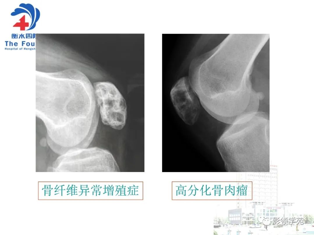 影像PPT - 【PPT】髌骨肿瘤的影像特点-37 影像PPT - 【PPT】髌骨肿瘤的影像特点-37