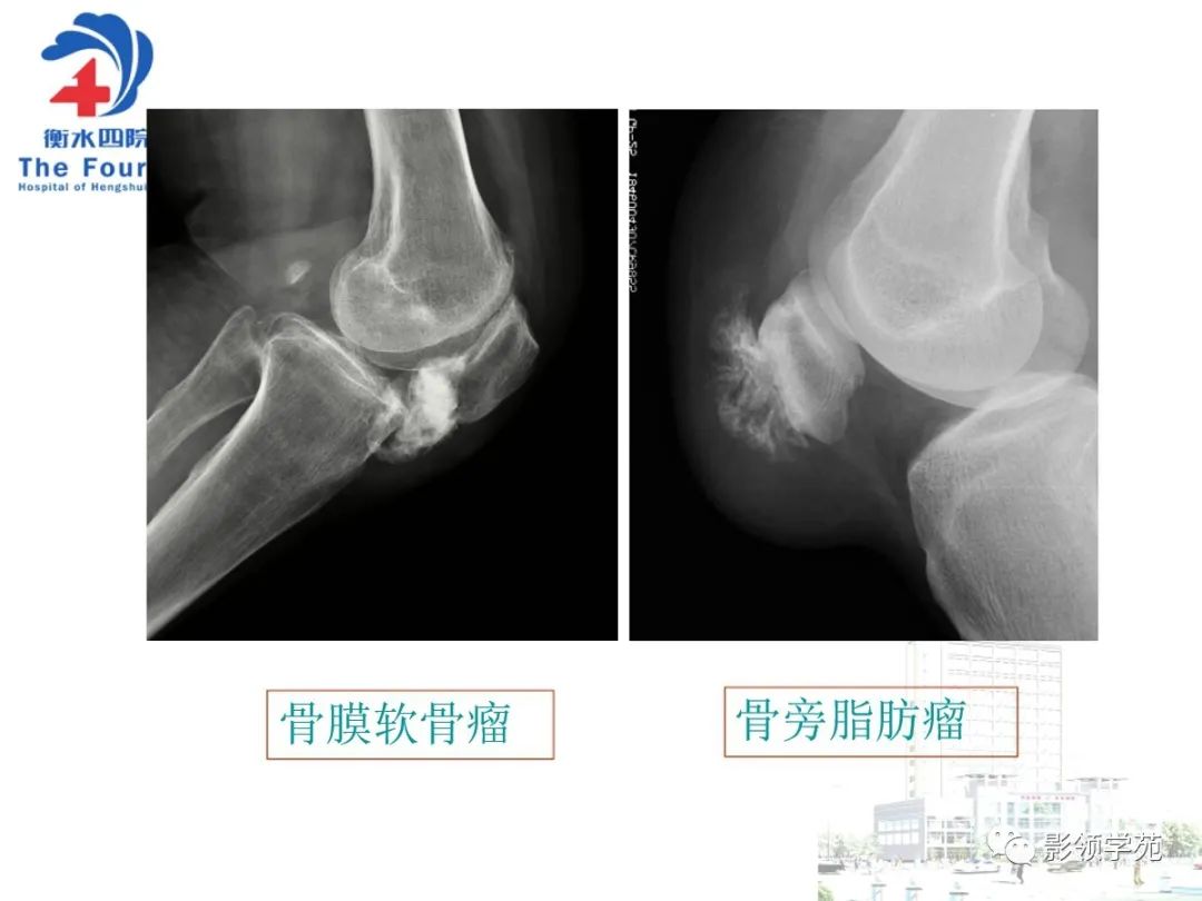 影像PPT - 【PPT】髌骨肿瘤的影像特点-38 影像PPT - 【PPT】髌骨肿瘤的影像特点-38