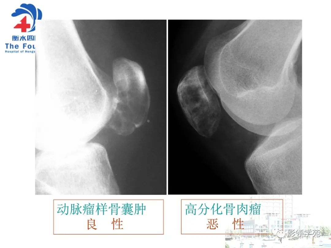 影像PPT - 【PPT】髌骨肿瘤的影像特点-41 影像PPT - 【PPT】髌骨肿瘤的影像特点-41