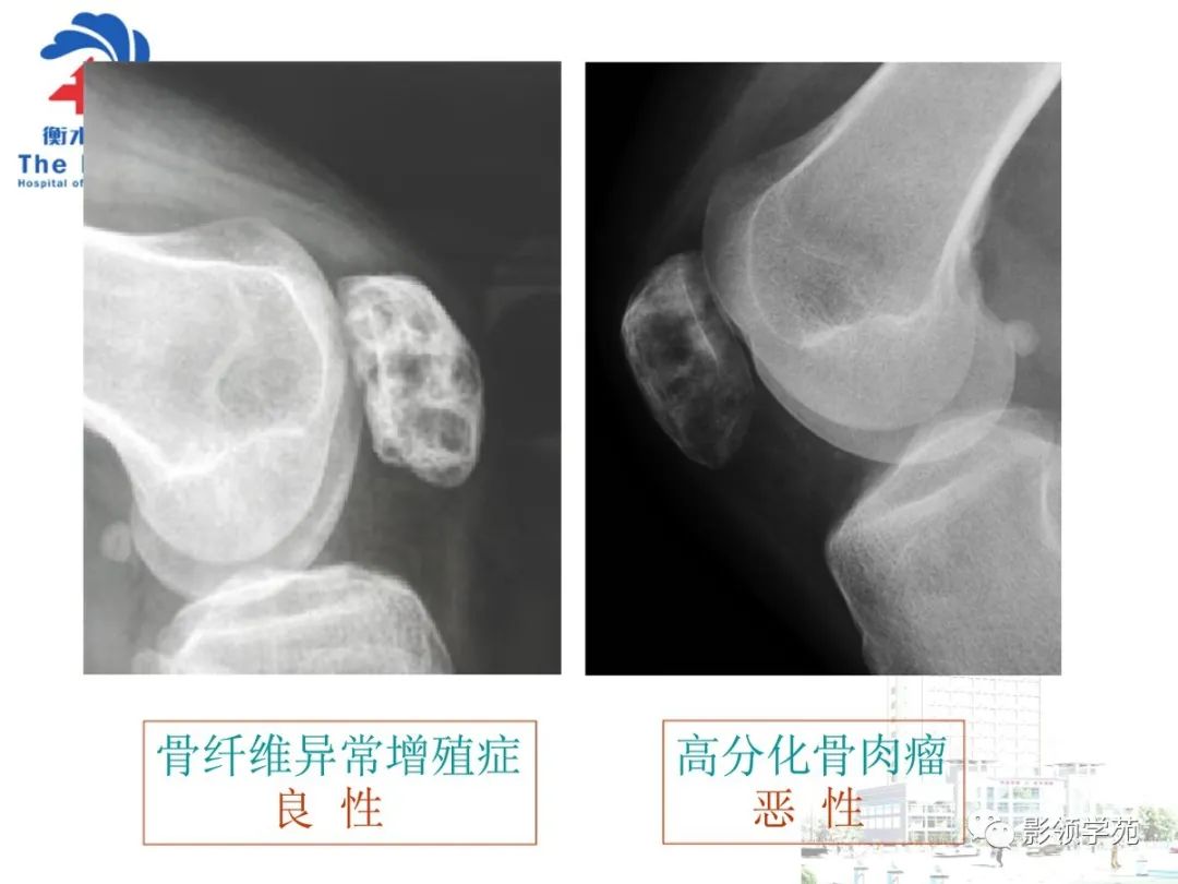 影像PPT - 【PPT】髌骨肿瘤的影像特点-39 影像PPT - 【PPT】髌骨肿瘤的影像特点-39
