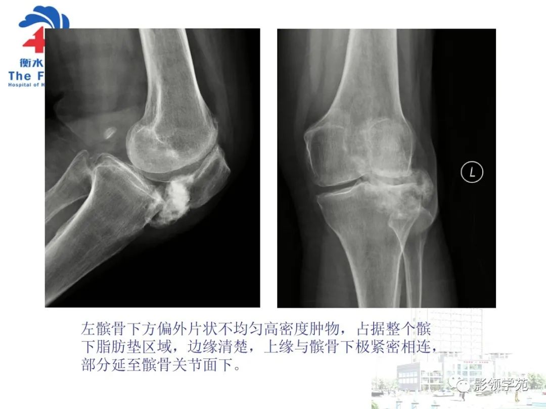 影像PPT - 【PPT】髌骨肿瘤的影像特点-6 影像PPT - 【PPT】髌骨肿瘤的影像特点-6