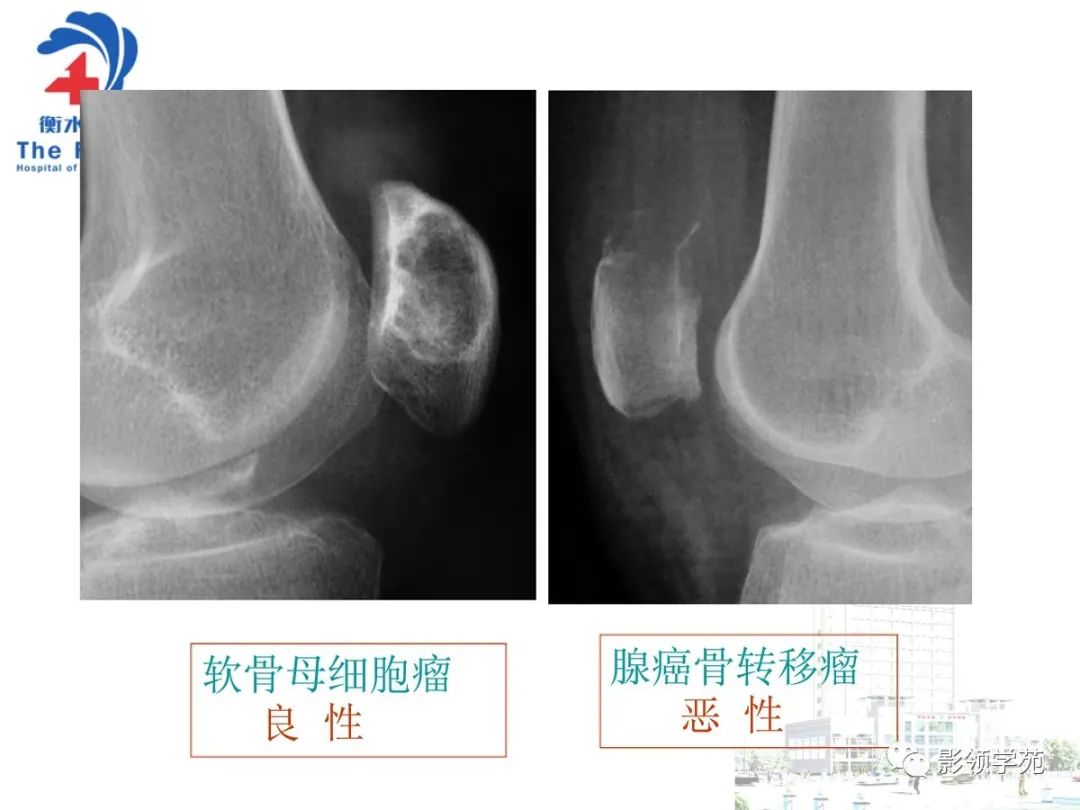 影像PPT - 【PPT】髌骨肿瘤的影像特点-8 影像PPT - 【PPT】髌骨肿瘤的影像特点-8