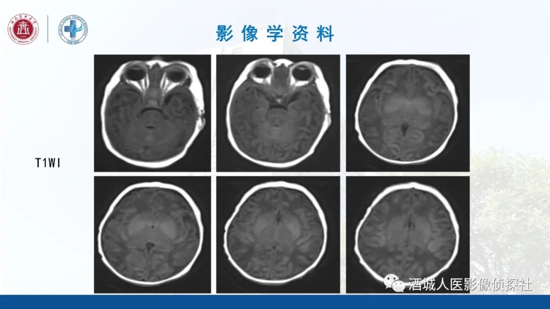 影像PPT - 【PPT】过目难忘的枫糖尿病-4