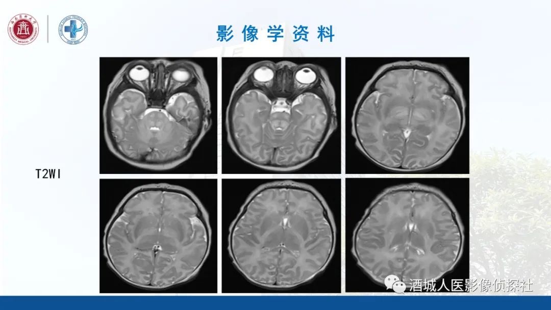 影像PPT - 【PPT】过目难忘的枫糖尿病-5