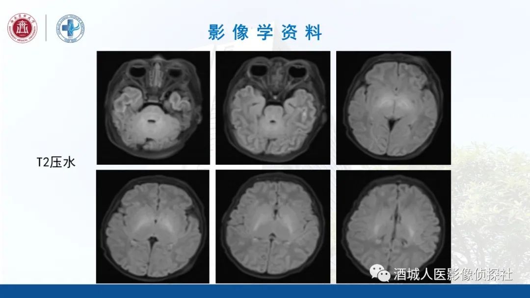 影像PPT - 【PPT】过目难忘的枫糖尿病-6