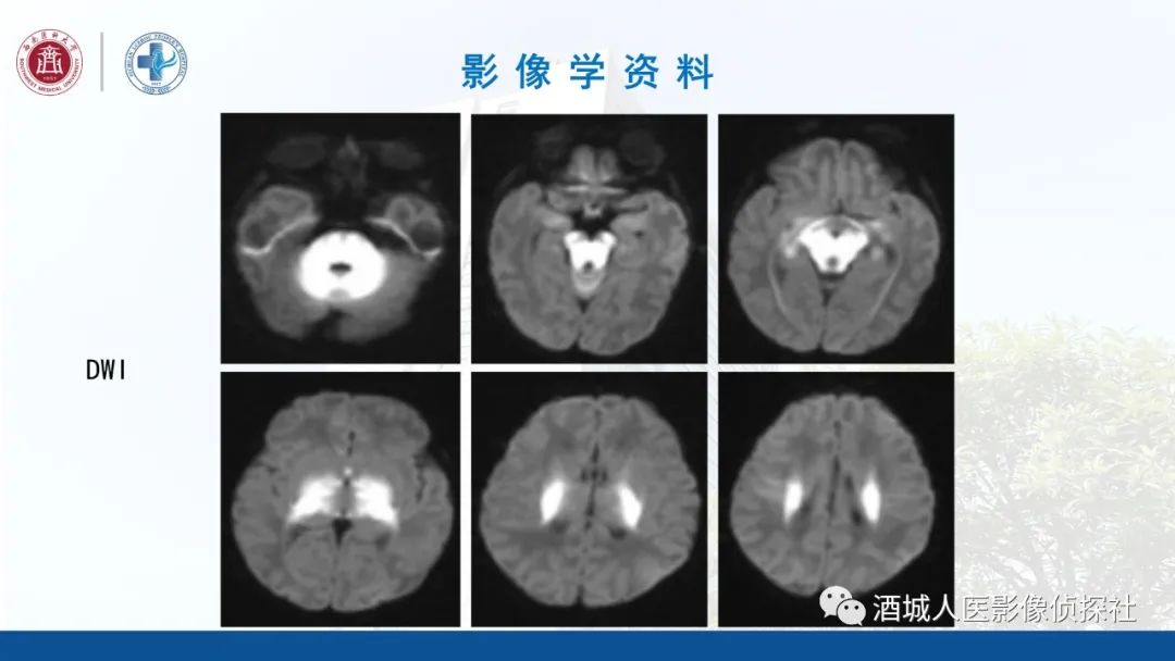 影像PPT - 【PPT】过目难忘的枫糖尿病-7