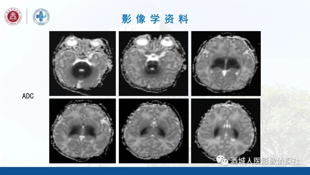 影像PPT - 【PPT】过目难忘的枫糖尿病-8