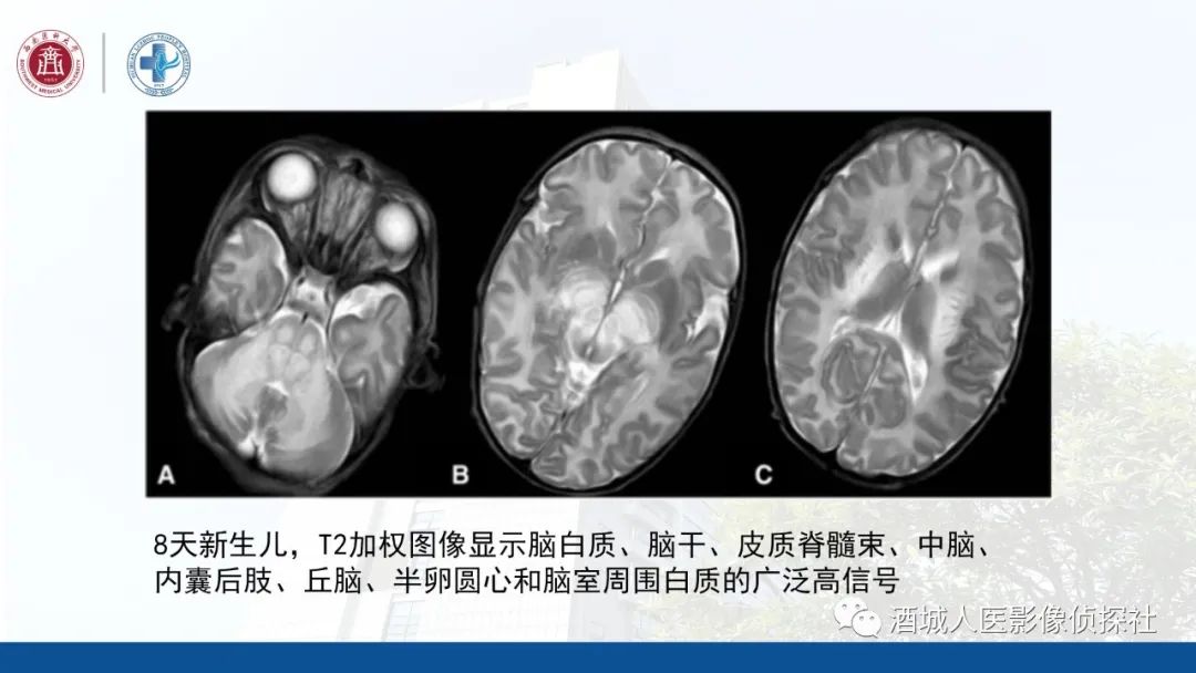 影像PPT - 【PPT】过目难忘的枫糖尿病-16