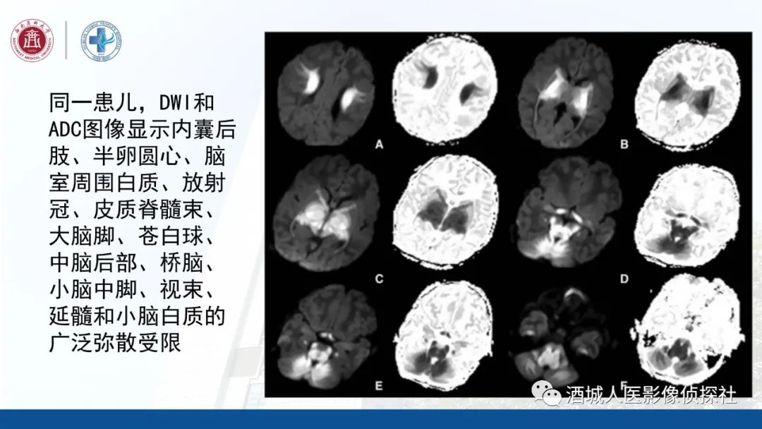 影像PPT - 【PPT】过目难忘的枫糖尿病-17