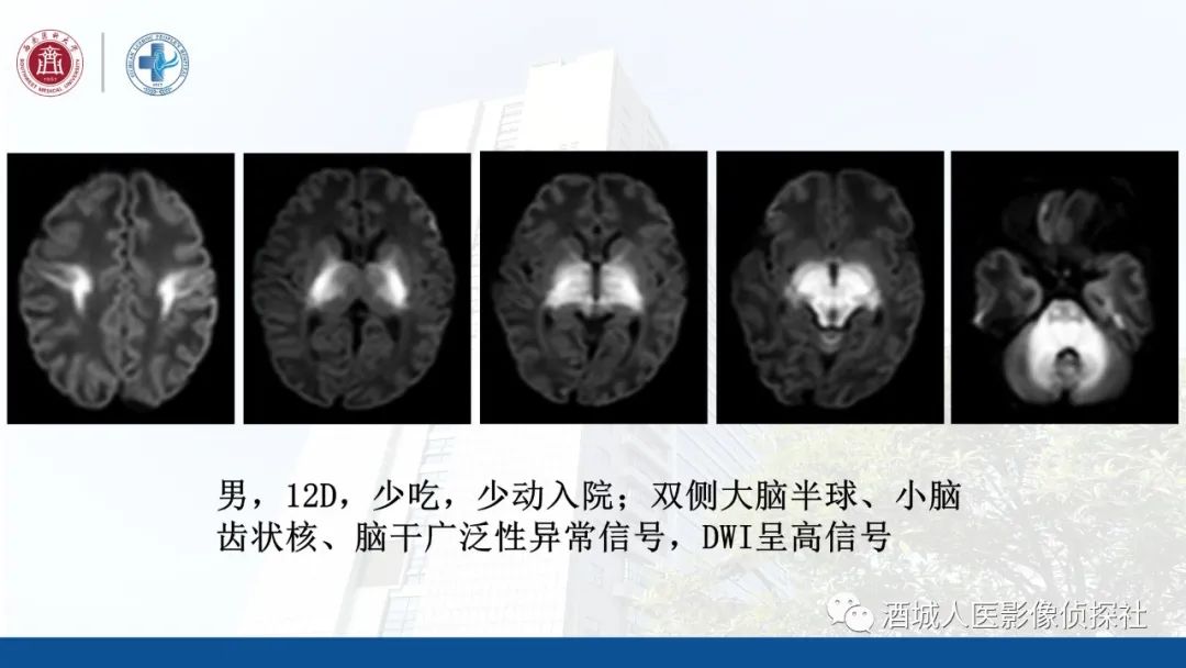 影像PPT - 【PPT】过目难忘的枫糖尿病-18