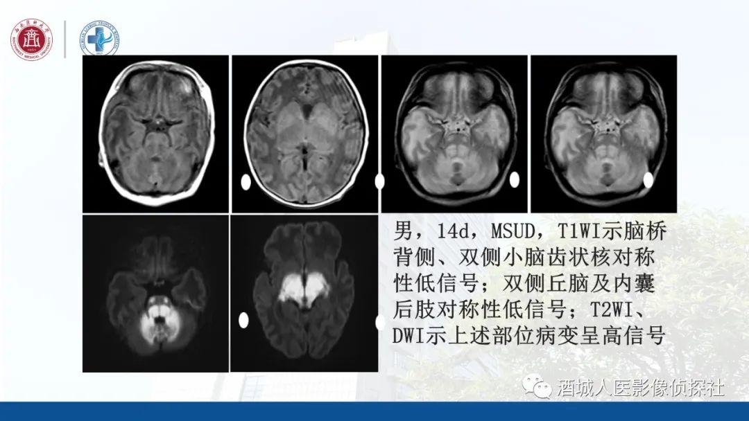 影像PPT - 【PPT】过目难忘的枫糖尿病-19