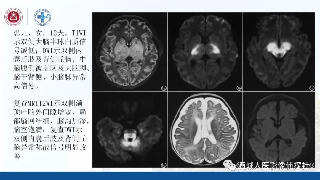 影像PPT - 【PPT】过目难忘的枫糖尿病-20