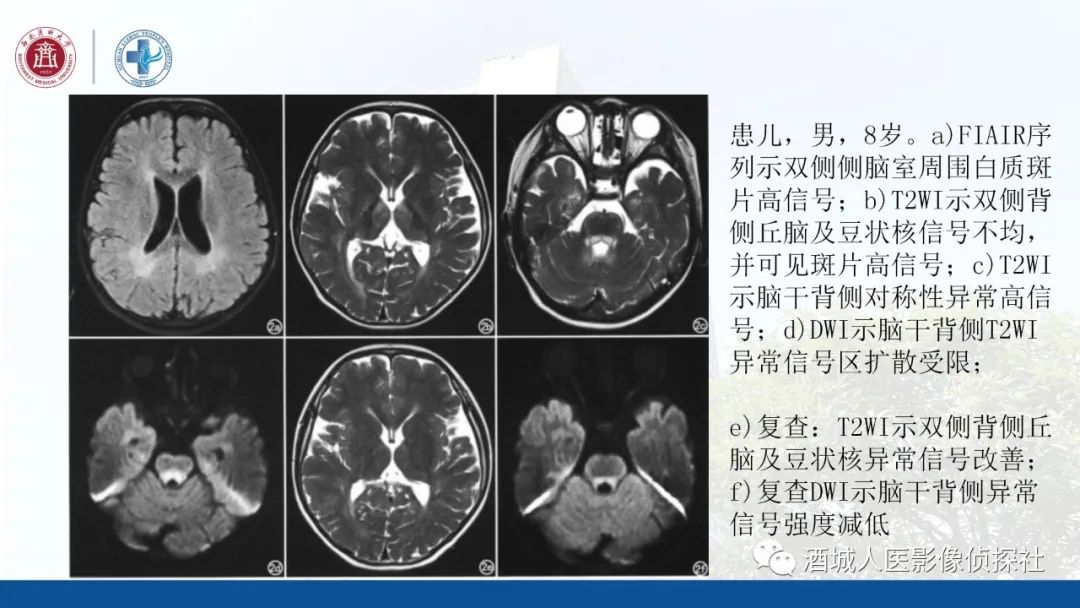 影像PPT - 【PPT】过目难忘的枫糖尿病-21