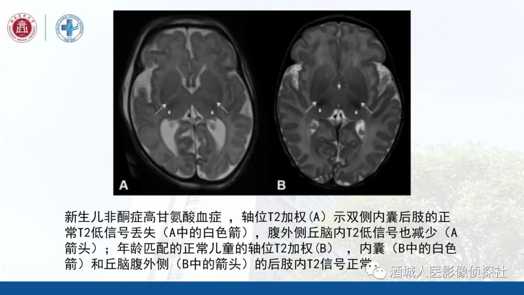 影像PPT - 【PPT】过目难忘的枫糖尿病-25