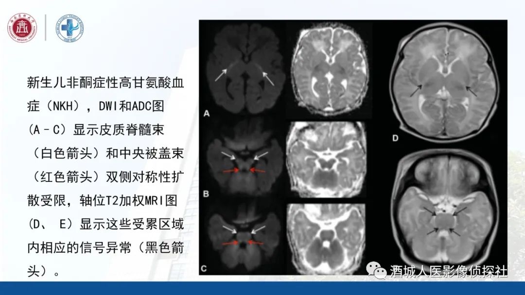 影像PPT - 【PPT】过目难忘的枫糖尿病-26