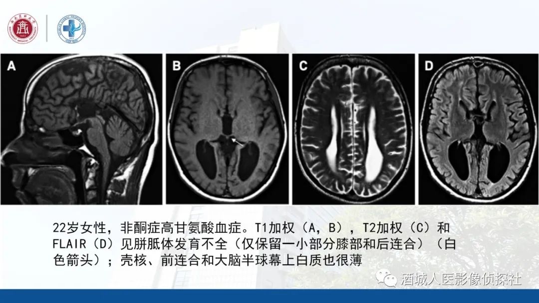 影像PPT - 【PPT】过目难忘的枫糖尿病-27