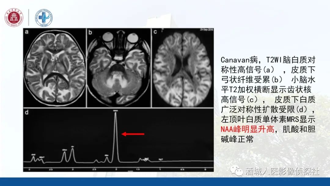 影像PPT - 【PPT】过目难忘的枫糖尿病-31
