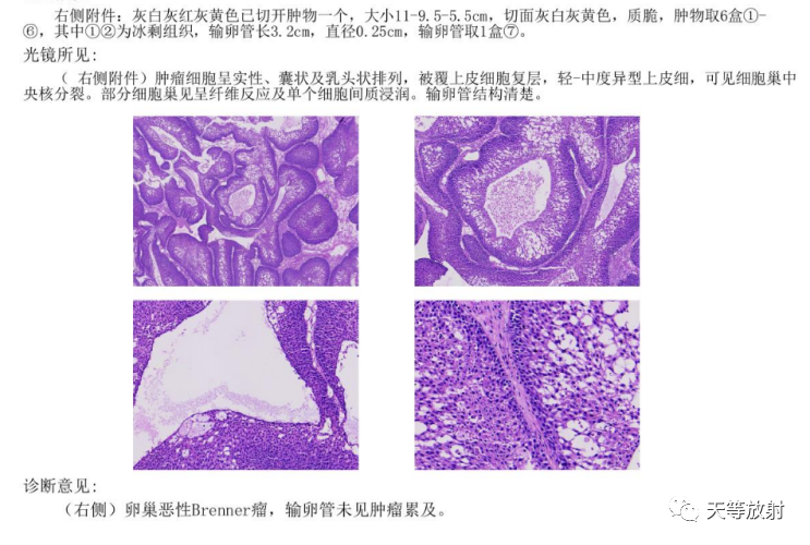 影像PPT - 【病例】卵巢恶性Brenner瘤1例MR-10 影像PPT - 【病例】卵巢恶性Brenner瘤1例MR-10