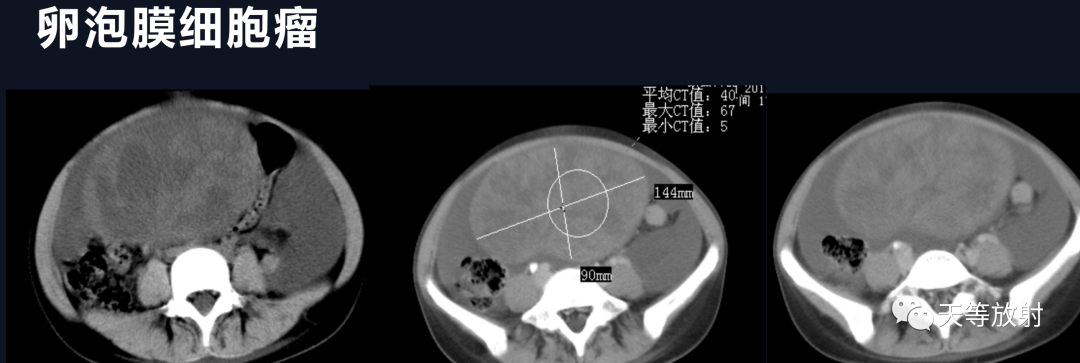 影像PPT - 【病例】卵巢恶性Brenner瘤1例MR-21 影像PPT - 【病例】卵巢恶性Brenner瘤1例MR-21