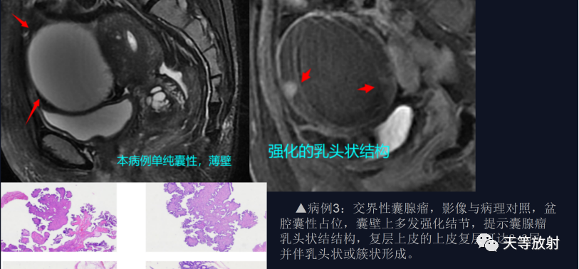 影像PPT - 【病例】卵巢恶性Brenner瘤1例MR-22 影像PPT - 【病例】卵巢恶性Brenner瘤1例MR-22