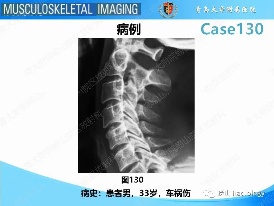 影像PPT - 【PPT】C2过伸骨折-2