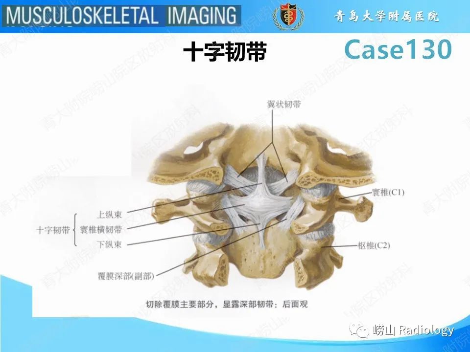 影像PPT - 【PPT】C2过伸骨折-10