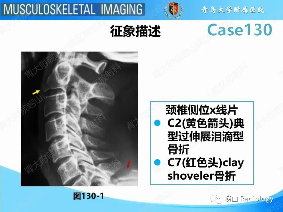 影像PPT - 【PPT】C2过伸骨折-14